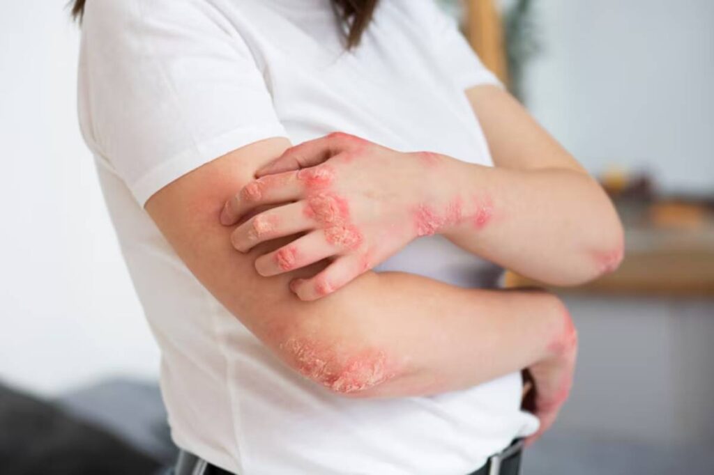 Woman in a white shirt with visible red, scaly patches on her arms, indicating a skin condition. She is crossing her arms contemplatively.