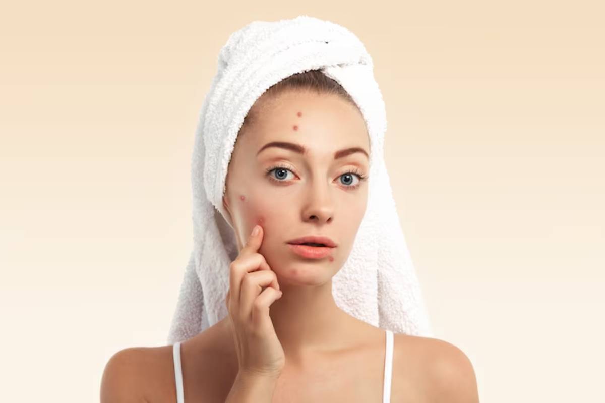 A woman with a towel on her head, pointing her acne on chin thoughtfully.